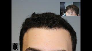 2,594 Graft FUE Hair Transplant Results at One Year | Chicago Hair Transplant Clinic | Dr. Panine