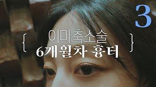 이마축소술 후기는 이거로 마지막 6개월차