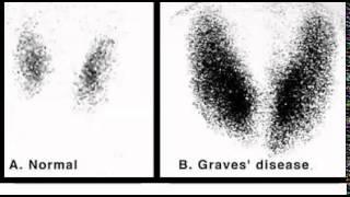 Thyroid scanning