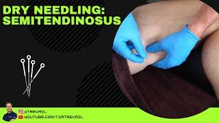 Dry Needling: Semitendinosus