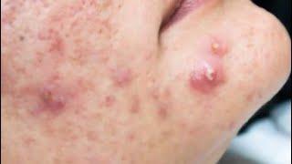 Acne Treatment For Hung (P7) Điều Trị Mụn Cho Hùng (P7) - SacDepSpa#2023