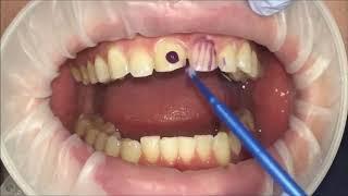 Veneers