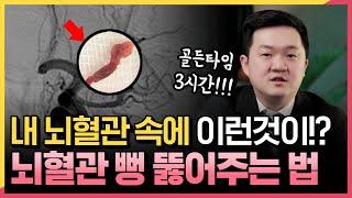 치명적인 뇌졸중, 이제 수술없이 막힌 뇌혈관 뚫어… | 혈전제거술