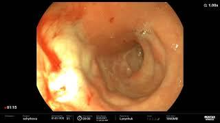 Endoscopic Treatment of Upper Gastrointestinal Ulcer Bleeding/ Эндоскопичесский гемостаз