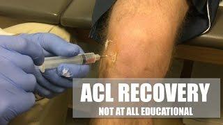 Torn ACL AGAIN from basketball! My 2 week recovery in under 3 minutes