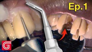 HOW TO Remove OLD ZIRCONIA Crowns on ANTERIOR Teeth | Ep 1