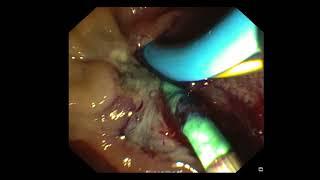 Endoscopic Ampullectomy