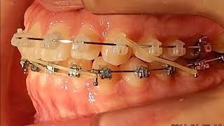 ortodonti, braket (About The Look Orthodontics) dental art,diş teli,ortodonti hakkında