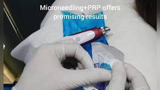 PRP+Microneedling for melasma,pigmentation, acne scars &skin rejuvenation by dr AminYousaf lahore pa