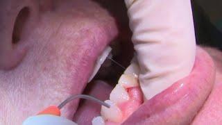 Dental laser kills bacteria