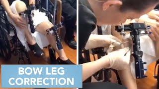 Bow Leg Correction Post-Op clip