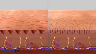 Derma Pen Vs Derma roller for Beard and Hair Growth