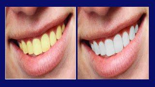 How to Whiten Teeth in Photoshop   Easy Tutorial for a Brighter Smile