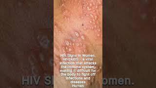 HIV/AIDS SIGNS AND SYMPTOMS IN WOMAN  https://youtu.be/ICPJcosSGTU