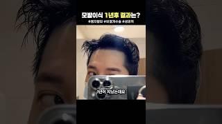 모발이식 고민중이면 꼭 보세요