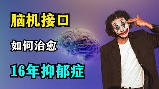 【科学】脑机接口治愈16年抑郁症 | 脑起搏器 | 电极刺激神经核团 | 上海瑞金医院 | 孙伯民