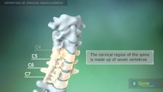 Cervical radiculopathy. Definition