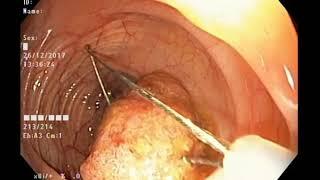 Polypectomy of huge colon polypus in left side colon - colonoscopy