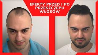 Przeszczep włosów - efekty przed i po. Tak będziesz wyglądać 3 lata po zabiegu. Metoda FUE.