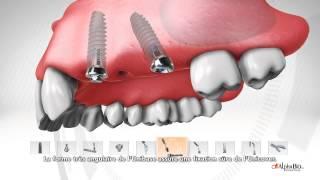 Système de piliers Multi-Unit par ALPHA-BIO TEC.