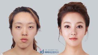 Double Jaw Surgery Asymmetrical Face, Korea Plastic Surgery  Let Me In TV Show,