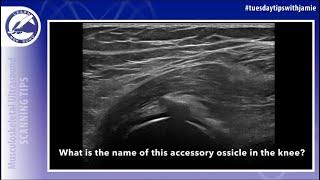 Do you know the name of this accessory ossicle in the posterolateral knee?