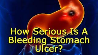 How Serious Is A Bleeding Stomach Ulcer?