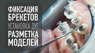 Брекеты– фиксация, установка дуг, разметка моделей | стоматология и ортодонтия самара влог