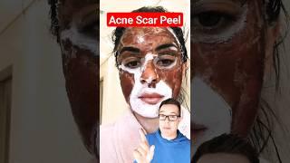 DRAMATIC CHEMICAL PEEL - Phenol Peel For Acne Scars #shorts