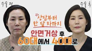 안면거상 수술로 20년 젊어진 비결 | 60대 주부 안면거상, 상안검, 하안검 수술 브이로그