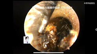 Satisfying Removal Video With Dr Zhao Binaural in a child, 10 min