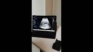 Ultrassom gemelar 7 semanas / Twin ultrasound 7 weeks