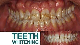 Bright White Smile | Teeth Whitening | Before and After | Chicago Beautiful Smiles