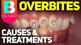 Deep Overbite Bite & Braces: Causes and Correction / Orthodontic Treatments