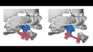 Mandible distraction. Elongate lower jaw to cure obstructive  sleep apnea snoring prs