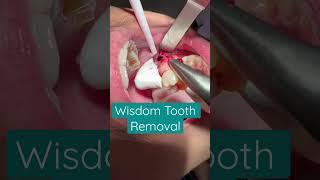 Wisdom Tooth Removal