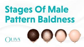 7 Stages of Male Pattern #Baldness Explained by The Best Dermatologist | Oliva skin & Hair Clinic