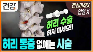 끊어질 것 같은 허리 통증, 간단하게 시술로 통증 없애기  | 시술 후, 바로 일상생활 가능 | 척추관 협착증 | 고주파 열 응고술 | 명의