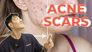 How to Treat Pigmented Acne Scars | Dr Davin Lim