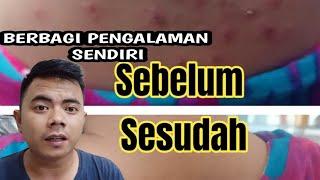 SEMBUH TOTAL DARI SCABIES  #scabiespadamanusia