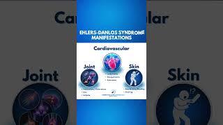 Ehlers Danlos Syndrome - Manifestations #shorts