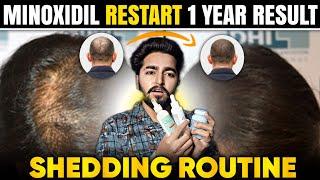 Minoxidil Restart 1 Year Results, Shedding and Routine