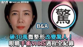 【砸30萬微整形改變驚人 眼睛手術9hrs過程全紀錄】｜@ilovesukilee