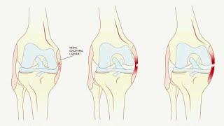 Hidden Areas of Knee: "MCL" in ACL Injuries