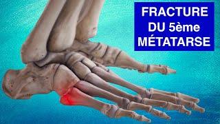 FRACTURE DE LA BASE DU CINQUIÈME MÉTATARSE : Explications, Diagnostic et Traitements