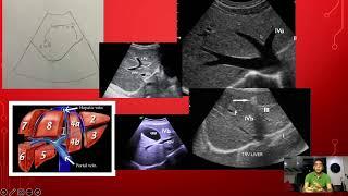 ULTRASOUND-LIVER SEGMENTS COUINAUD'S CLASSIFICATION