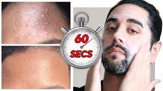 Better Skin In 60 Seconds? Remove Acne, White Bumps, Blackheads In 60 Seconds A Day   James Welsh