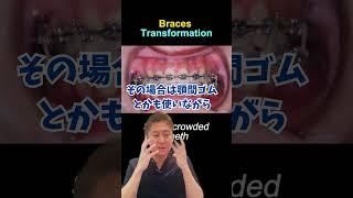 We focus on your bite when giving treatment. #dentist #orthodontics #Kamata #dentist #orthodontic...