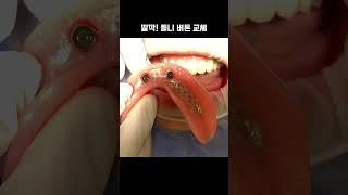 임플란트 2개로 탄탄틀니 #틀니 #디지털정원장