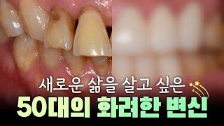 50대도 찾는 치아교정과 보철치료 (feat.지르코니아 크라운)